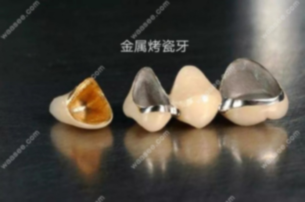 13岁做烤瓷牙