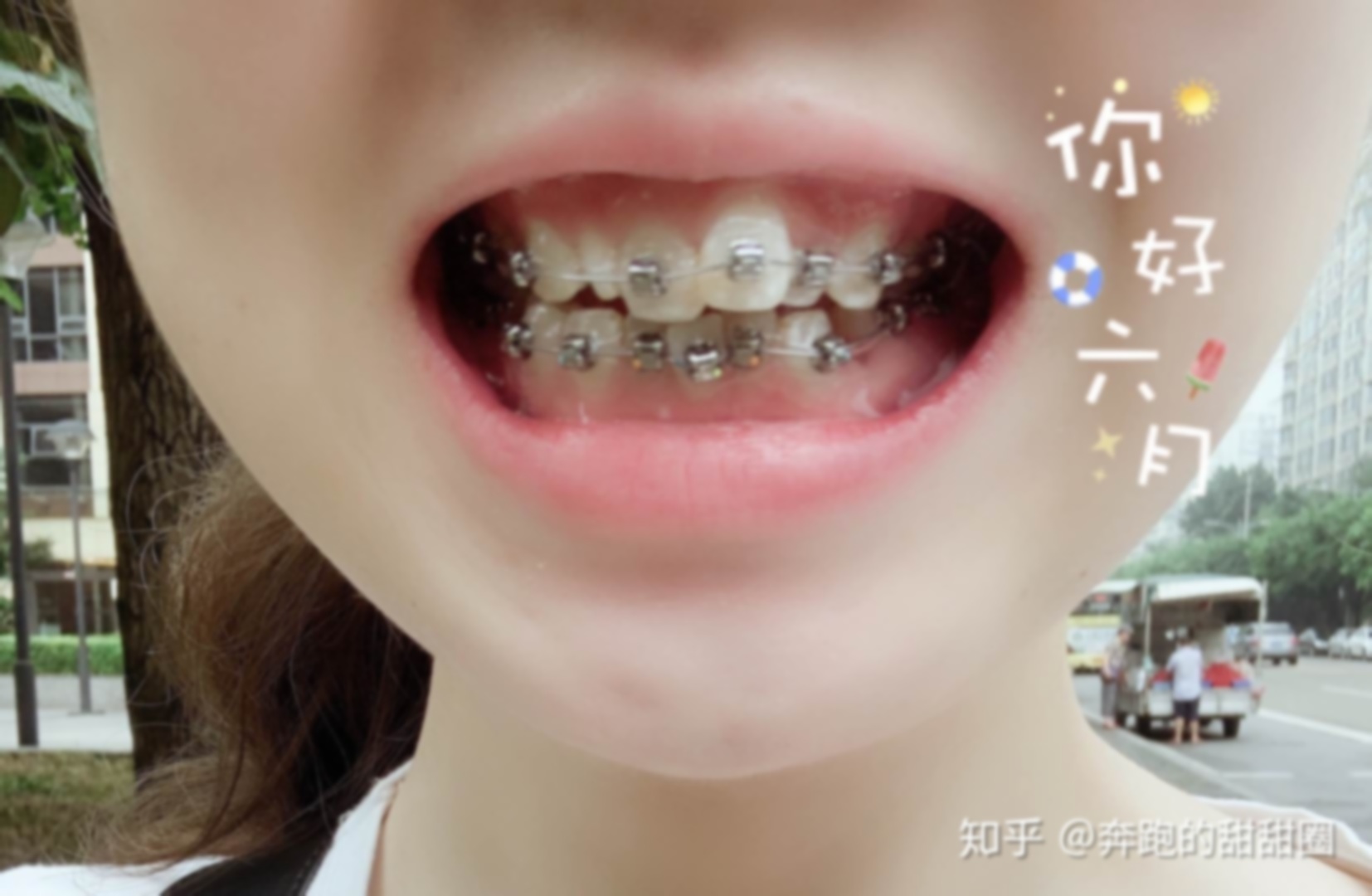 30岁满口假牙女炎