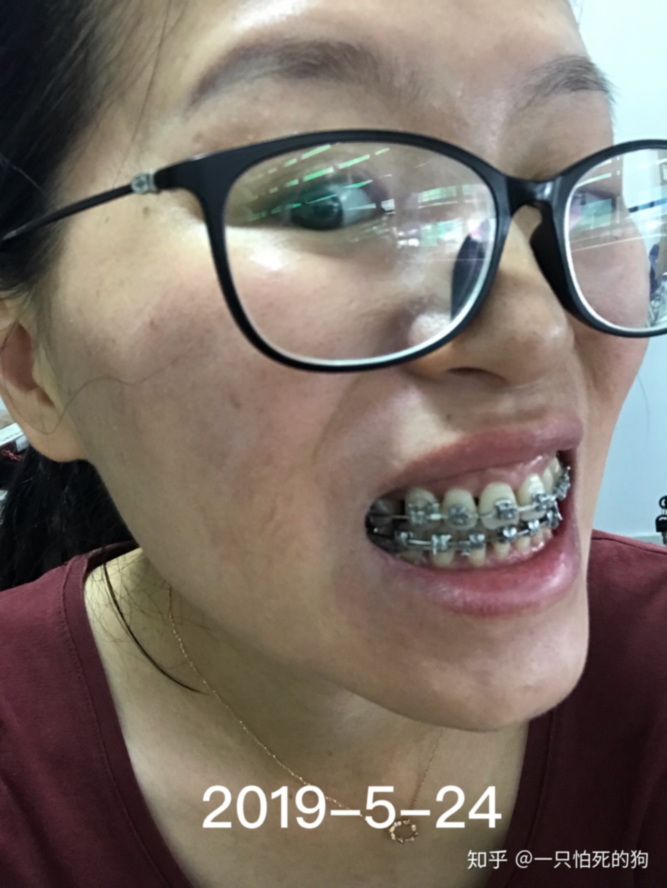 30多岁满口假牙