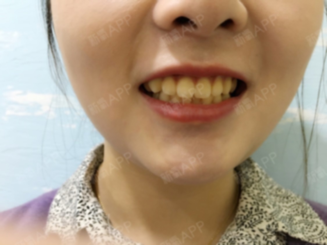 做完瓷贴面