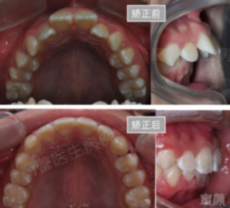 龇牙是怎么回事