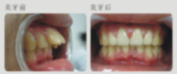 龅牙是怎么形成的