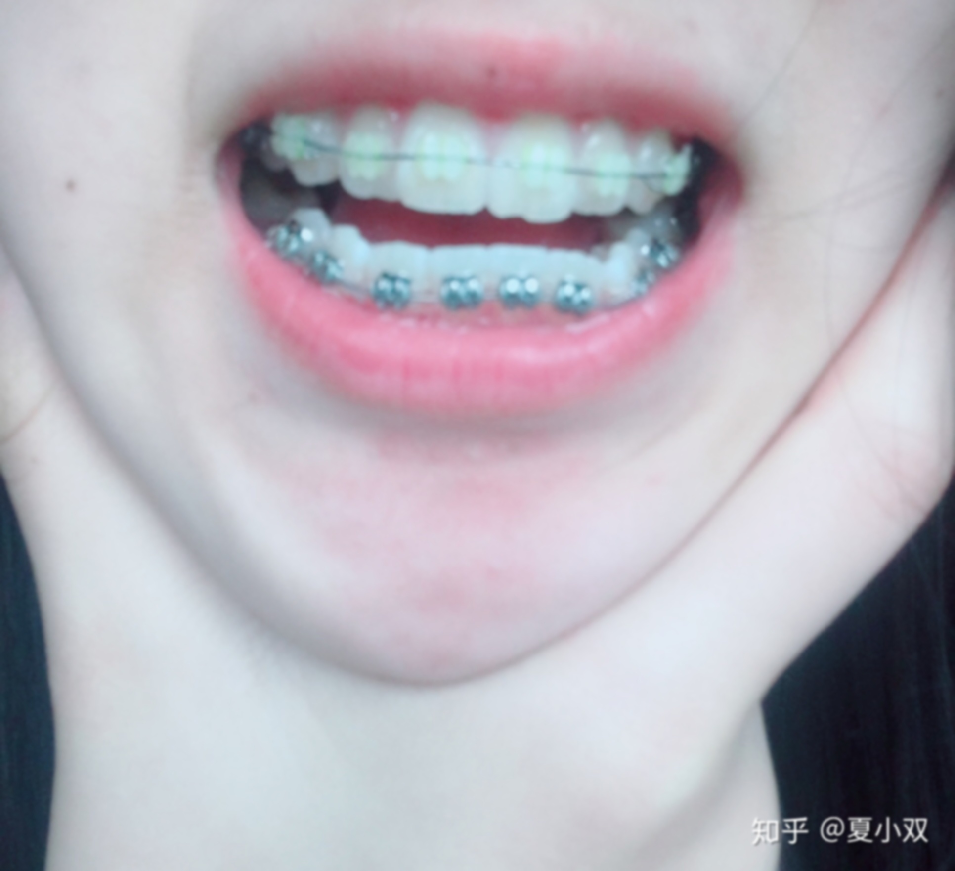 保持器多久不戴会戴不上
